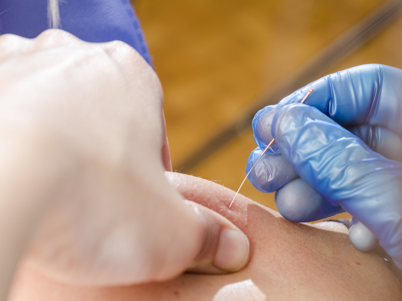 Dry needling