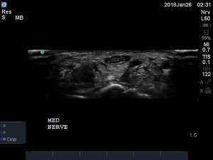 Nervus medianus opgenomen met Edge