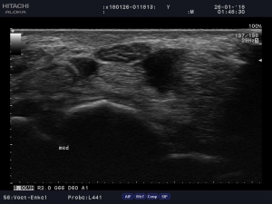 Nervus medianus opgenomen met Arietta Prologue