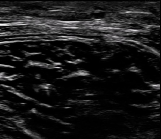 Soleus Victory