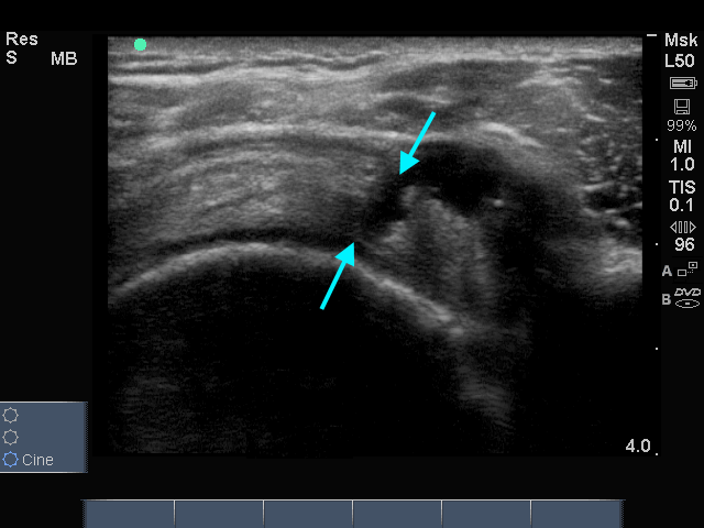 Supraspinatus rechts (dwarse opname, pijnlijke zijde)