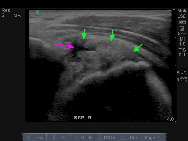 Supraspinatus rechts (lengte opname, pijnlijke zijde)