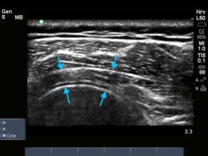 Infraspinatus links
