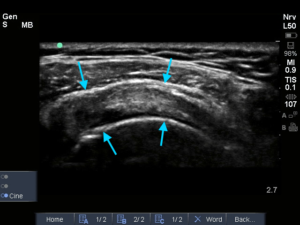 Supraspinatus links (dwarse opname)