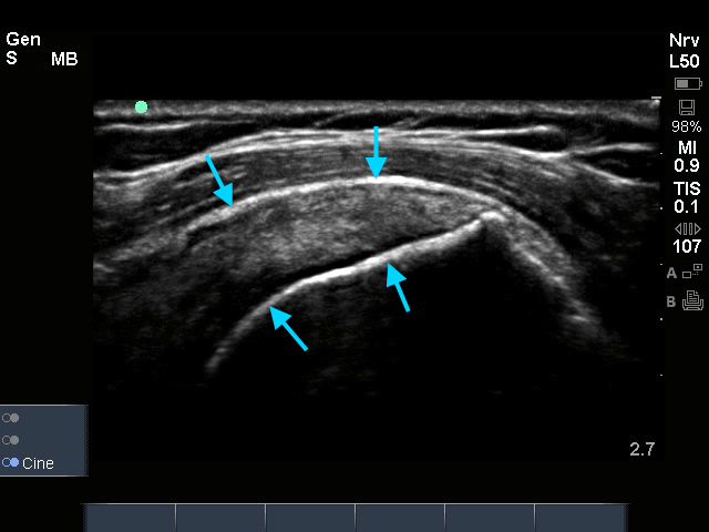 Supraspinatus links
