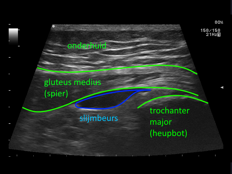 Bursitis m. gluteus medius