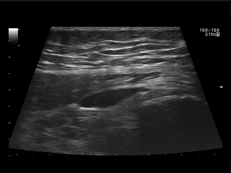 Bursitis gluteus medius